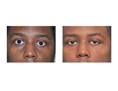 What causes upper half of iris to be covered | Looksmax.org - Men's Self-Improvement & Aesthetics