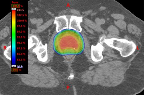 RACGP - Advances in radiotherapy technology for prostate cancer: What every GP should know