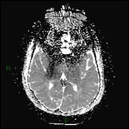 MRI artifact - dental braces | Radiology Case | Radiopaedia.org