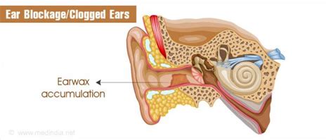 Clogged Ears: Causes, Picture, Symptoms And Treatment