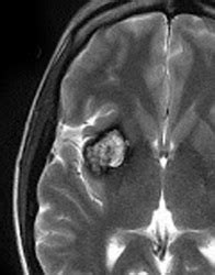 Susceptibility artifact - Questions and Answers in MRI