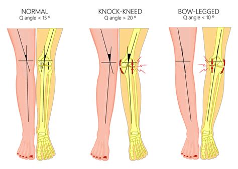 Varus knee (bow-legged) correction in young adults : Part 3 - Bangkok ...