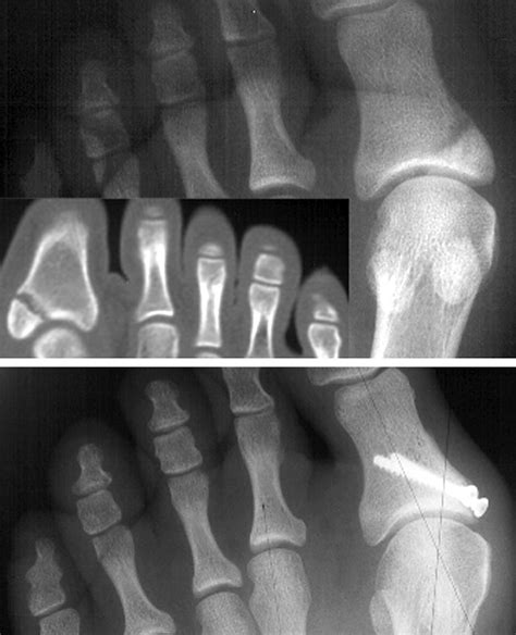 Proximal Phalanx Fracture