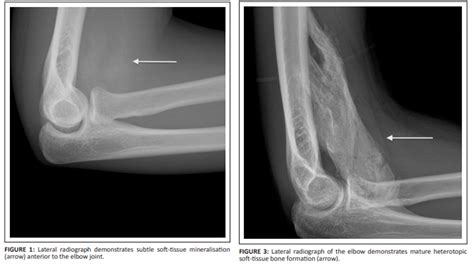 Myositis Ossificans : Emergency Care BC