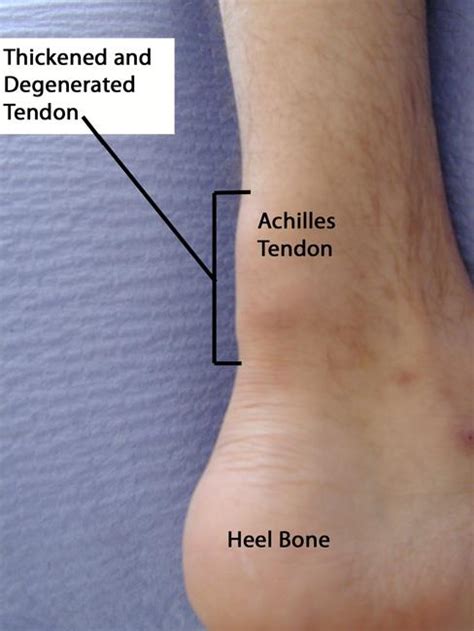 Sprains, Strains and Other Soft-Tissue Injuries - OrthoInfo - AAOS