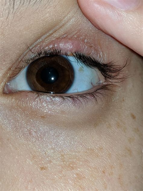 Update to eye stye post pop (it popped on its own when I sneezed) there's still some stuff in ...