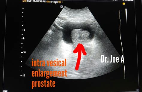 Ultrasound imaging: Unusually large prostate 3D ultrasound