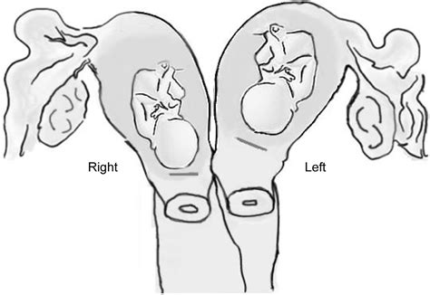 Double Uterus - Causes, Symptoms, Complications