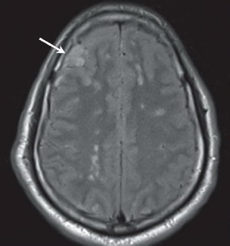 Diffuse Axonal Injury | Radiology Key