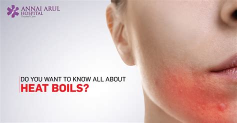 DO YOU WANT TO KNOW ALL ABOUT HEAT BOILS? – Multispeciality Hospitals ...