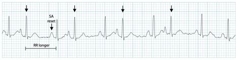 cardiology - Difference between Premature Atrial Contraction and Atrial Fibrillation - Biology ...