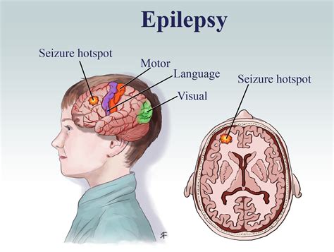 EPILEPSY What Are Seizures and Epilepsy? Epilep