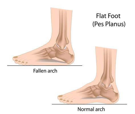 Flat Feet Fallen Arch Infographic - Horizon Foot & Ankle Institute