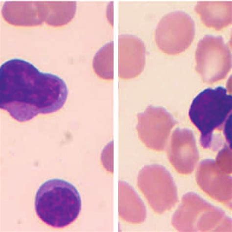 ANKL. The leukemic cells are large with variable amount of cytoplasm,... | Download Scientific ...