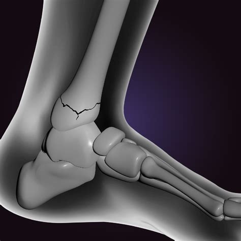 Causes of Ankle Fracture – Welcome to SYS Medtech International Pvt. Ltd.