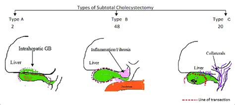 Schematic illustration of types of subtotal cholecystectomy | Download Scientific Diagram