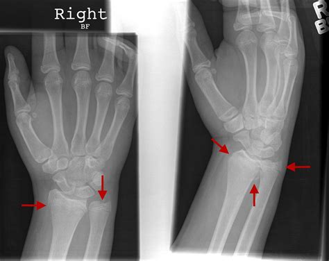 Fractures Of The Distal Radius And Distal Ulna With Ulnar Shortening | My XXX Hot Girl