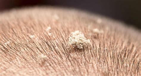 Can Dandruff Be Responsible For Hair Loss?