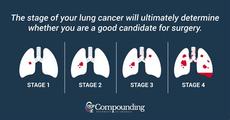 Learning That Your Lung Cancer Is “Inoperable” - ArticleCity.com