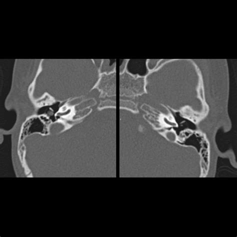 Pediatric Cholesteatoma | Pediatric Radiology Reference Article | Pediatric Imaging | @pedsimaging