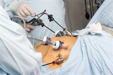 Bariatric Surgery: Preparation, Recovery, Long-Term Care