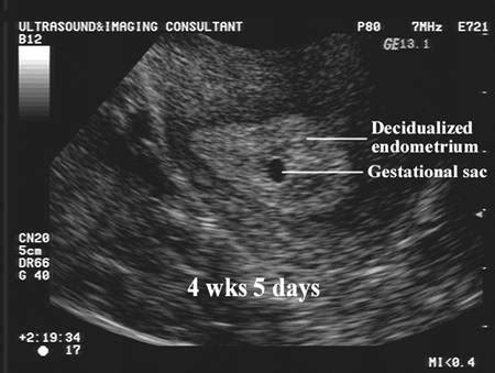 The Normal Gestational Sac