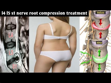 L4-L5-S1 nerve root compression treatment, disc bulge treatment without ...