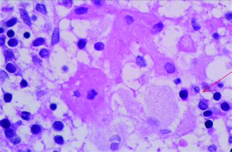 Bone marrow trephine biopsy specimen. Histological assessment revealed ...