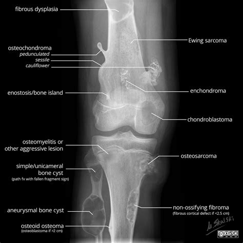 Can Bone Tumors In Dogs Be Benign