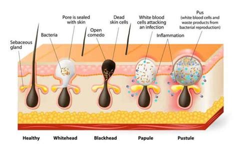 Boil vs Pimple- Differences with Pictures, Boil or Pimple?