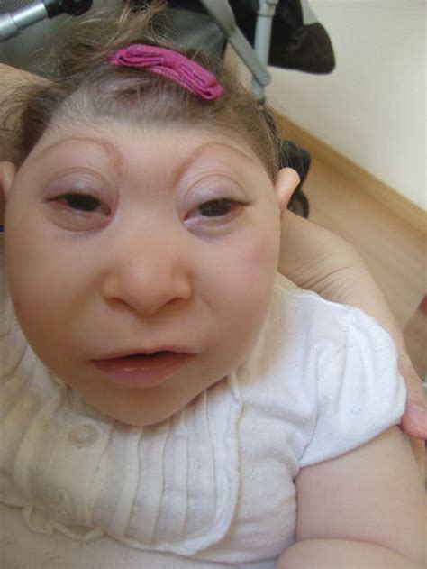 frog baby anencephaly - Google Search | Baby face, Graphic novel, Visual