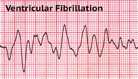 What Is Ventricular Fibrillation: Symptoms And Causes - First Aid Course Darwin