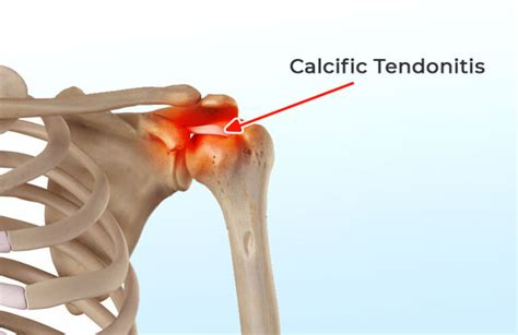 What is Calcific Tendonitis? A Comprehensive Overview | ASPC Manipulation Therapy