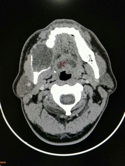 Ameloblastoma | Radiology, Diagnostic imaging, Head and neck