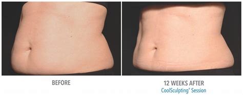 CoolSculpting Before and After with Pictures | Dermacare