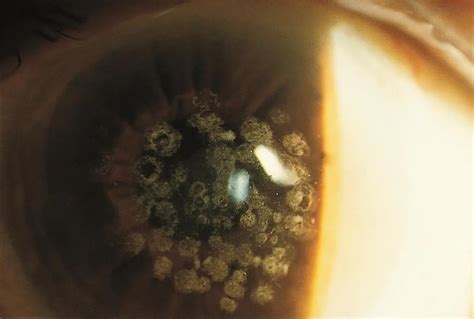 Granular corneal dystrophy - American Academy of Ophthalmology