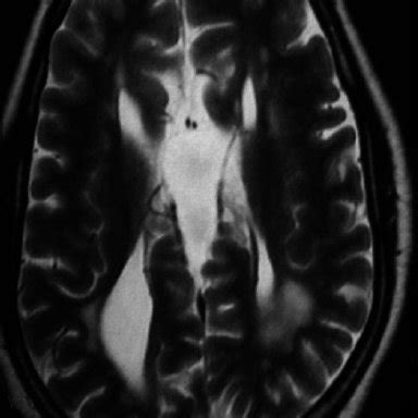 T2-weighted MRI, coronal section, showing right hippocampal atrophy in... | Download Scientific ...