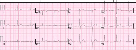 Dr. Smith's ECG Blog: Inferior Dynamic T-waves