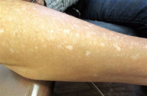 Idiopathic Guttate Hypomelanosis Vs Tinea Versicolor