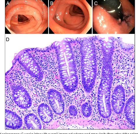 [PDF] De Novo Diagnosis of Lymphocytic Colitis After SARS-CoV-2 Vaccination | Semantic Scholar