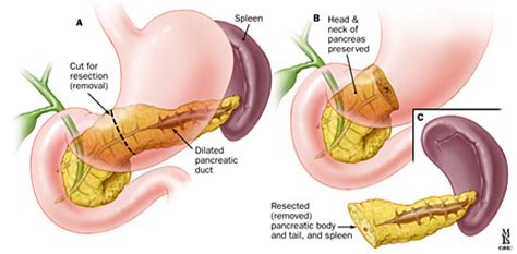 Surgeries for Pancreatitis: Frey Procedure and Distal Pancreatectomy