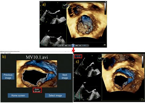 Automatic Measurement of the Mitral Valve Based on Echocardiography Using Digital Image ...