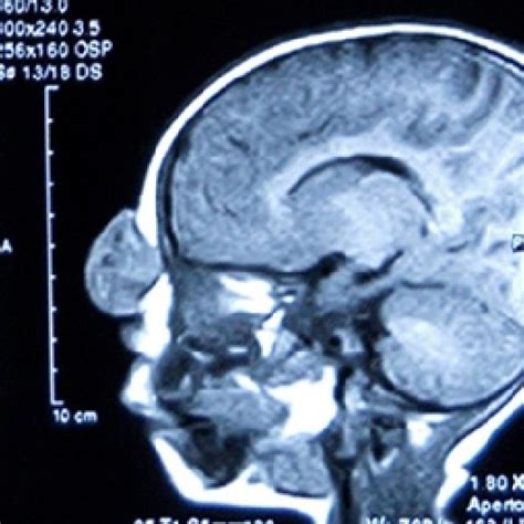 MRI of the brain shows a well-defined soft tissue attenuation lesion,... | Download Scientific ...