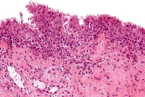 Pathology & Laboratory Medicine: Synovial Lining Hyperplasia