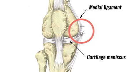 MCL Sprain - Symptoms, Treatment, Exercises & Rehabilitation