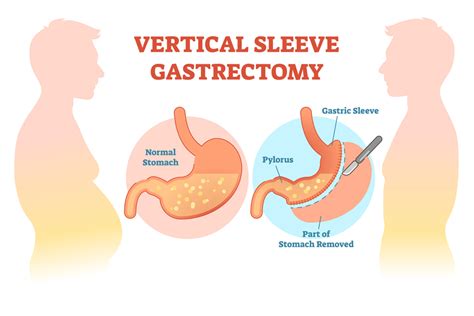 A Basic Guide To Understanding the Sleeve Gastrectomy Procedure