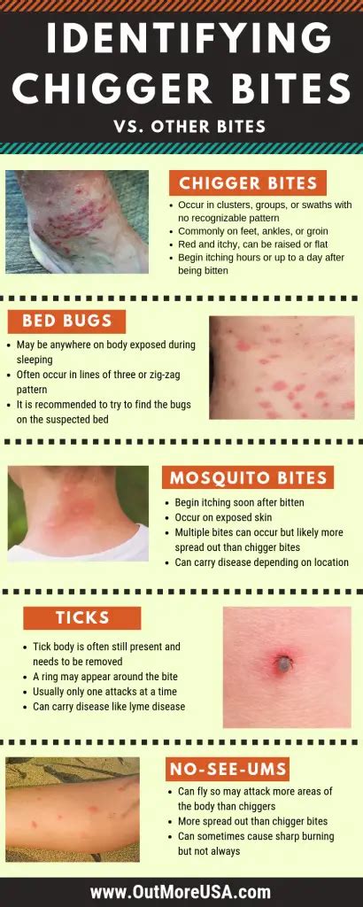 Identifying chigger bites - including pictures, treatment, and remedy ...