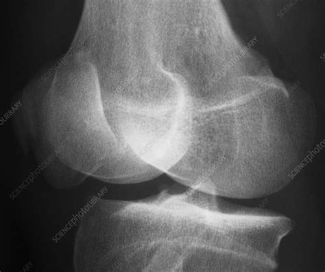 Fractured patella, x-ray - Stock Image - C021/1936 - Science Photo Library