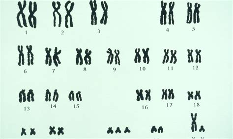 Down Syndrome - Symptoms, Treatment, and More