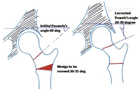 Valgus osteotomy in delayed presentation of femoral neck fractures ...